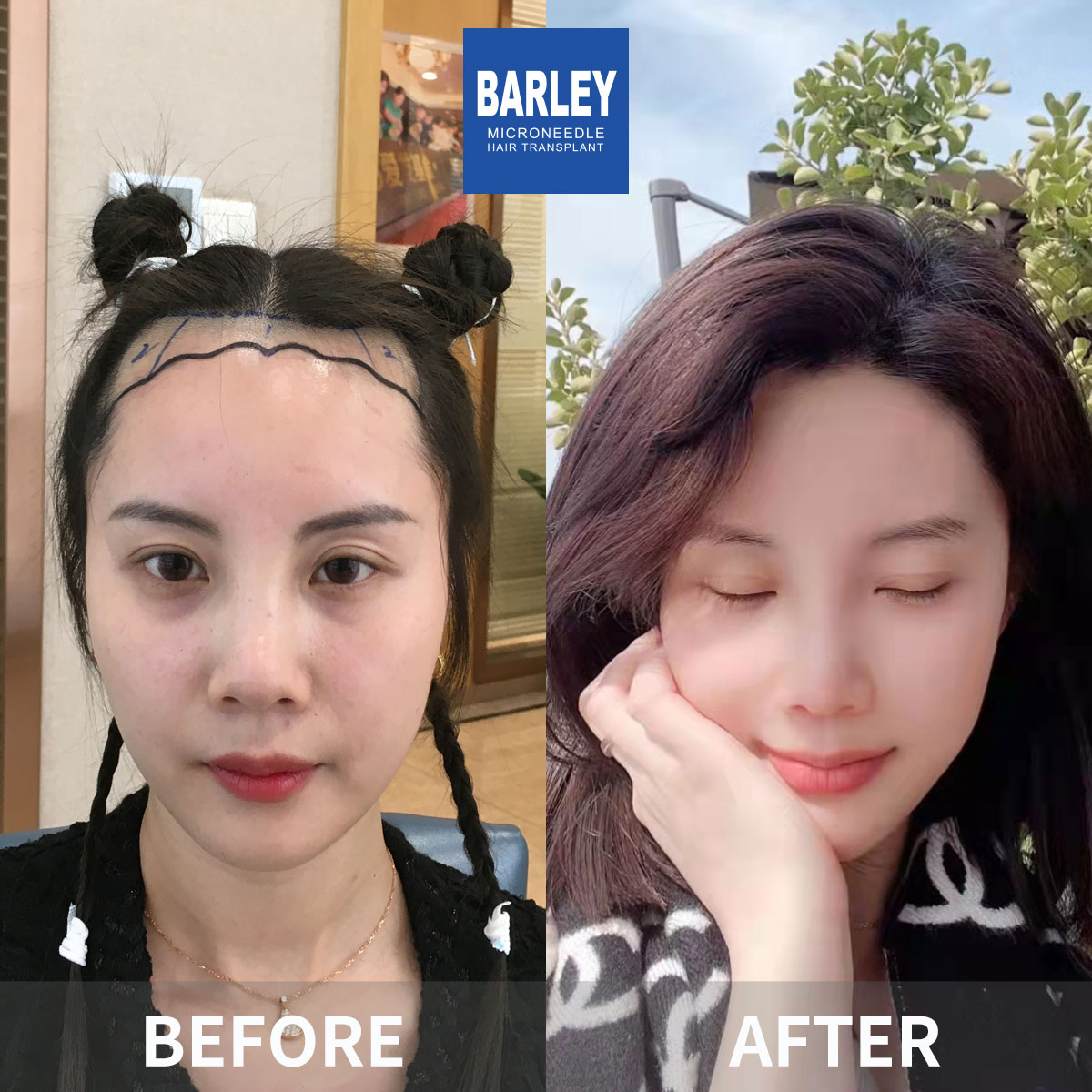 Female hair transplant before and after