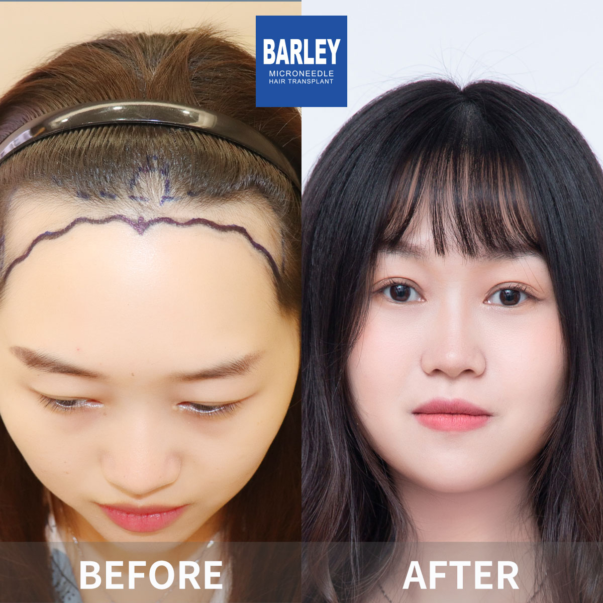 Female hair transplant before and after