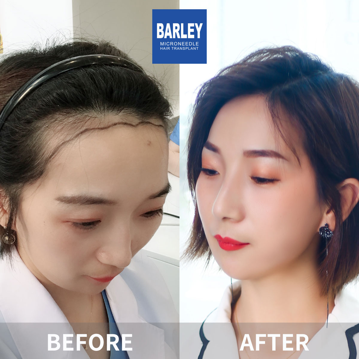 Female hair transplant before and after