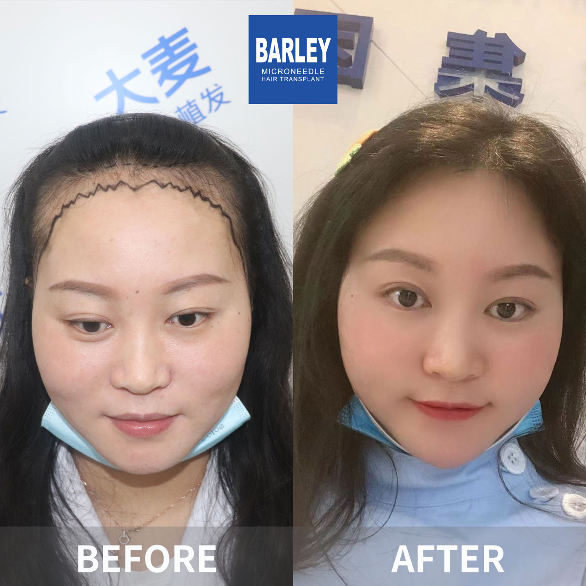 Hair Transplant in Jinan