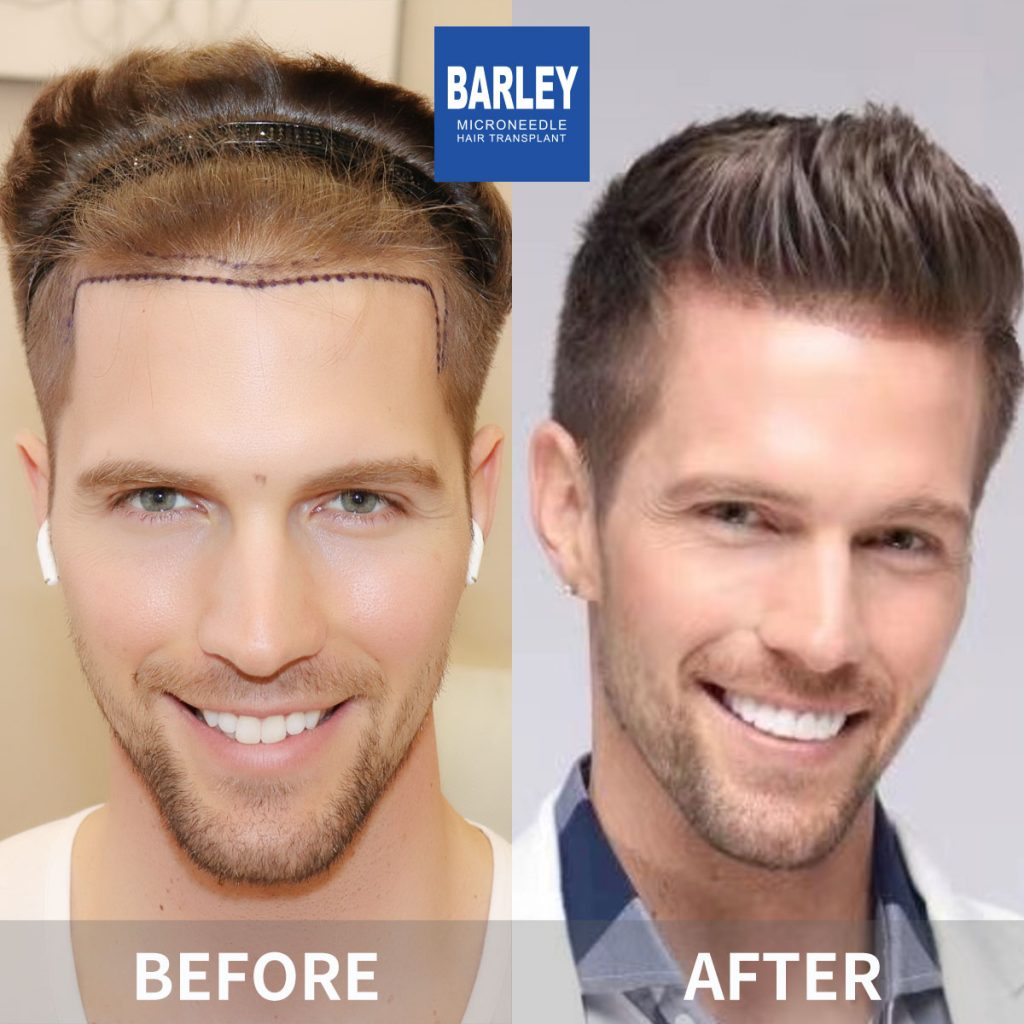 Best Affordable Hair Transplant in Hong Kong