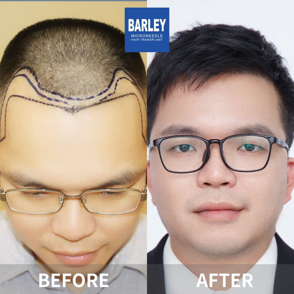 Hair Transplant in Nanchang