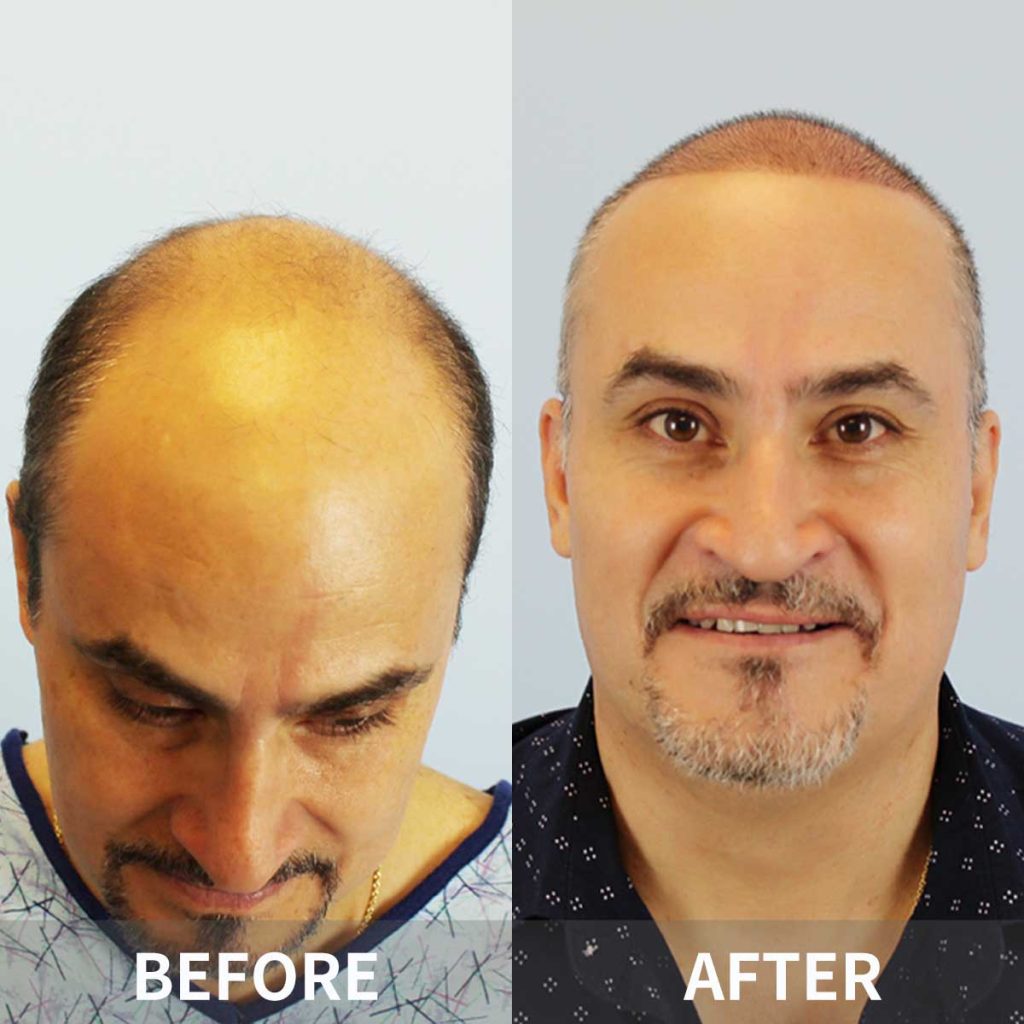 Hair Transplant in Xian