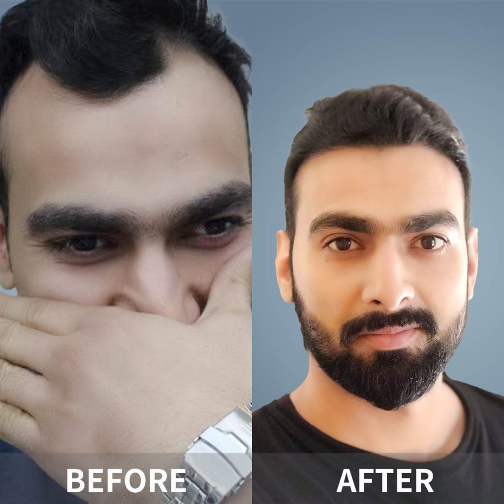 Hair Restoration in Guangzhou