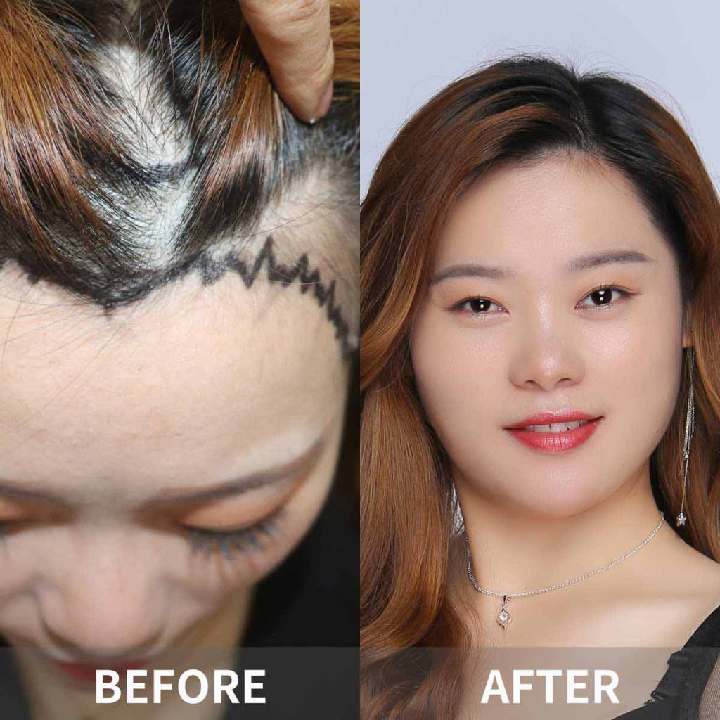 Hair Transplant in Hangzhou