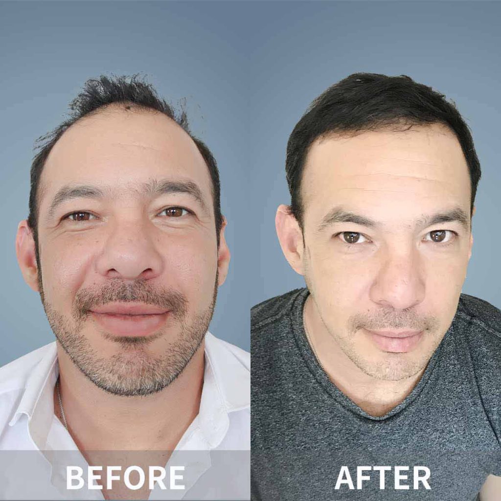 Hair Transplant in Dalian